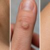 Skin Tags, Warts, and Moles:7 Warning Signs You Should Know
